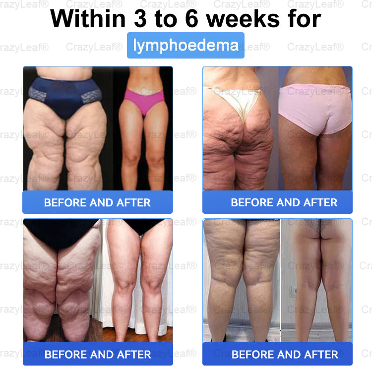 Only 10 boxes left! We're offering you an additional 40% discount! Get yourself in shape and healthy. Miss out now, and you won't have another chance until next year.CrazyLeaf®