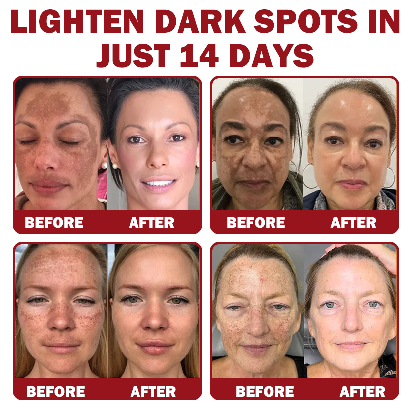 Only 5 jars! Grab an exclusive 50% discount now! Keep your skin youthful and glowing in just 1 to 4 weeks. Don’t miss your chance—this offer won’t come around again until next year. Act fast! 180-day money back guarantee!