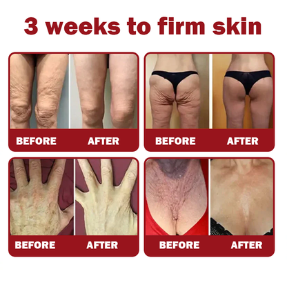 Only 5 jars! Grab an exclusive 50% discount now! Keep your skin youthful and glowing in just 1 to 4 weeks. Don’t miss your chance—this offer won’t come around again until next year. Act fast! 180-day money back guarantee!
