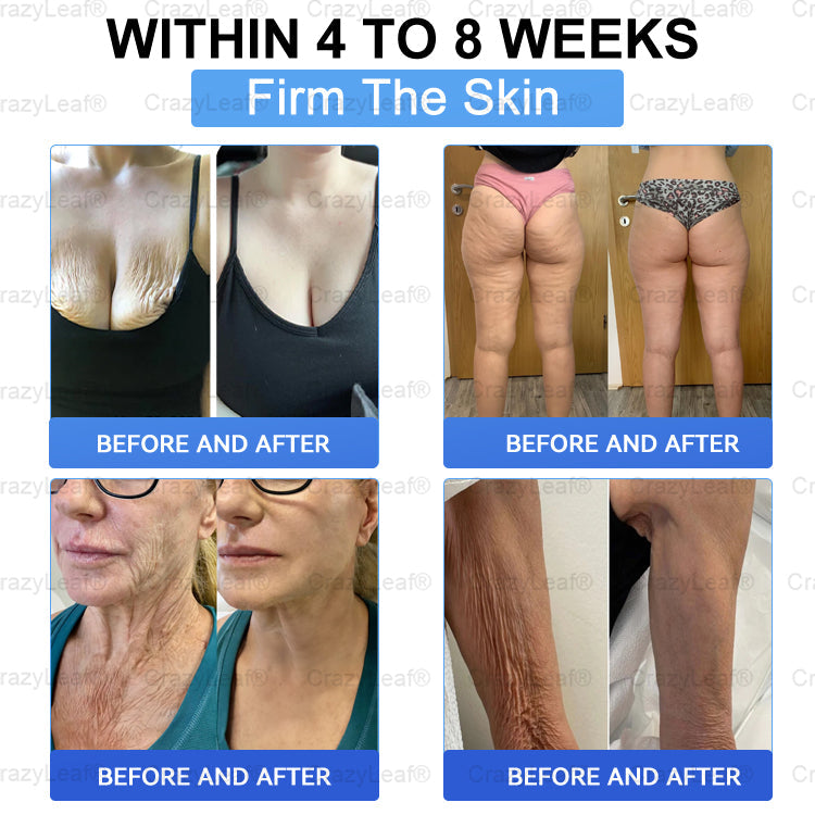 【Last Day Promotion 80% OFF🔥】 CrazyLeaf® 💙 Nano Microneedle Patch with SMGT-GLP-1, Matrixyl 3000, Botox & Collagen Peptides – Targets: Obesity, Skin Firmness, Cardiovascular Disease, Diabetes, Sleep Apnea, Joint Issues, and More