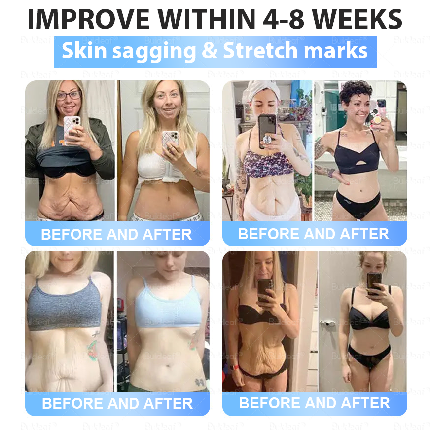 [ 𝑭𝒊𝒏𝒂𝒍 30 𝑴𝒊𝒏𝒖𝒕𝒆𝒔: 𝑩𝒖𝒚 5, 𝑮𝒆𝒕 5 𝑭𝒓𝒆𝒆! 🇨🇦]  𝑩𝒖𝒊𝒍𝒅𝒍𝒆𝒂𝒇® 𝑻𝒊𝒓𝒛𝒆𝒑𝒂𝒕𝒊𝒅𝒆 𝑺𝒍𝒊𝒎𝒎𝒊𝒏𝒈 & 𝑯𝒆𝒂𝒍𝒕𝒉 𝑵𝒂𝒏𝒐 𝑴𝒊𝒄𝒓𝒐𝒏𝒆𝒆𝒅𝒍𝒆 𝑷𝒂𝒕𝒄𝒉 𝒘𝒊𝒕𝒉 𝑪𝒐𝒍𝒍𝒂𝒈𝒆𝒏 & 𝑴𝒂𝒕𝒓𝒊𝒙𝒚𝒍 3000丨𝑻𝒂𝒓𝒈𝒆𝒕𝒔 𝑶𝒃𝒆𝒔𝒊𝒕𝒚, 𝑳𝒐𝒐𝒔𝒆 𝑺𝒌𝒊𝒏, 𝑯𝒊𝒈𝒉 𝑩𝒍𝒐𝒐𝒅 𝑷𝒓𝒆𝒔𝒔𝒖𝒓𝒆, 𝑫𝒊𝒂𝒃𝒆𝒕𝒆𝒔, 𝑭𝒂𝒕𝒕𝒚 𝑳𝒊𝒗𝒆𝒓, 𝑱𝒐𝒊𝒏𝒕 𝑷𝒂𝒊𝒏, 𝑩𝒓𝒂𝒊𝒏 𝑭𝒐𝒈, 𝑳𝒐𝒘 𝑬𝒏𝒆𝒓𝒈𝒚 𝒂𝒏𝒅 𝑴𝒐𝒓𝒆